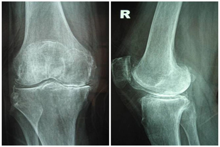 Hình ảnh X-quang của khớp xương bị thoái hóa