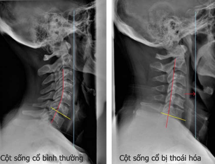 Hình ảnh chụp X-quang cột sống cổ bình thường và bị thoái hóa