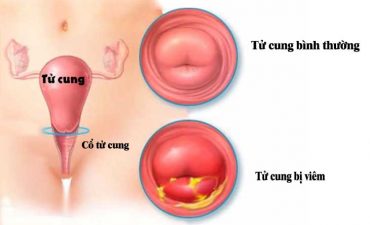 Viêm cổ tử cung là tình trạng các tế bào ở cổ tử cung bị tổn thương, viêm sưng, lở loét