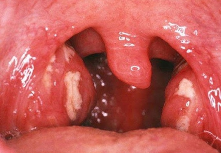 Viêm họng có đờm là một trong những bệnh hô hấp không hiếm gặp