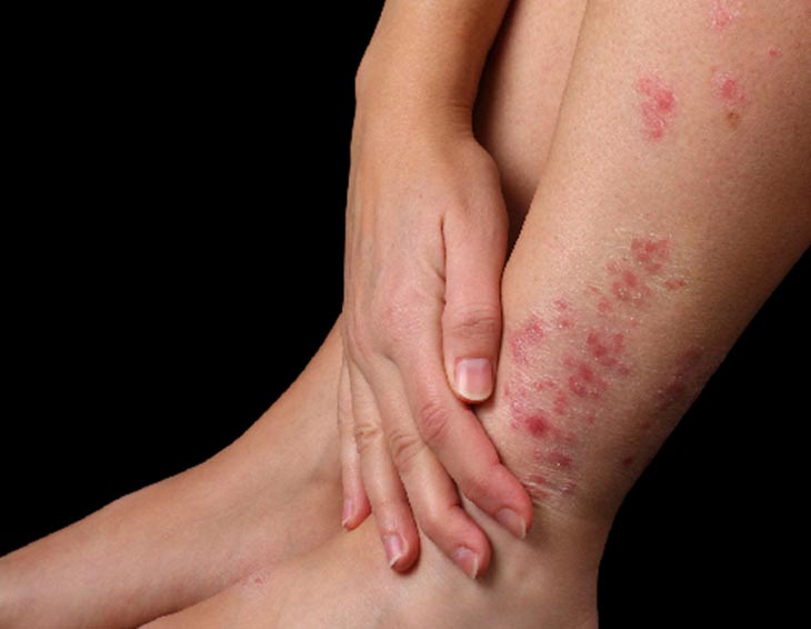 Vẩy nến ở da là biểu hiện điển hình của bệnh này