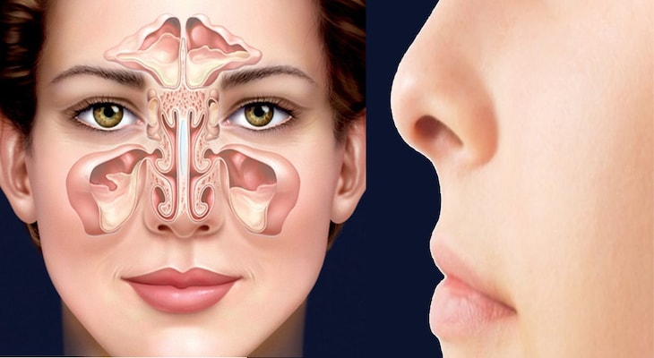 Viêm xoang mũi là bệnh hô hấp thường gặp phổ biến