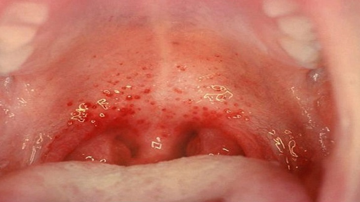 Bé bị viêm họng kéo dài có thể do liên cầu khuẩn