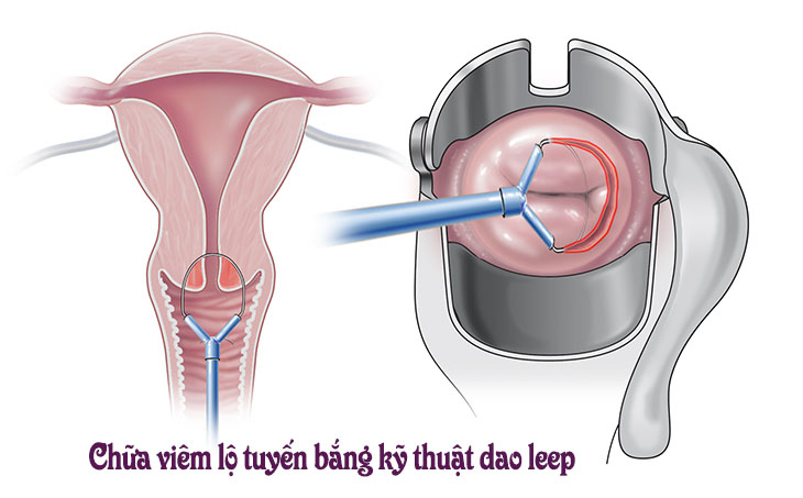 Kỹ thuật cắt leep cổ tử cung có ưu điểm là thực hiện nhanh, hiệu quả 