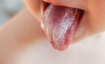 Lưỡi bé bị trắng quá nhiều rất dễ khiến cho bé mắc bệnh tưa lưỡi
