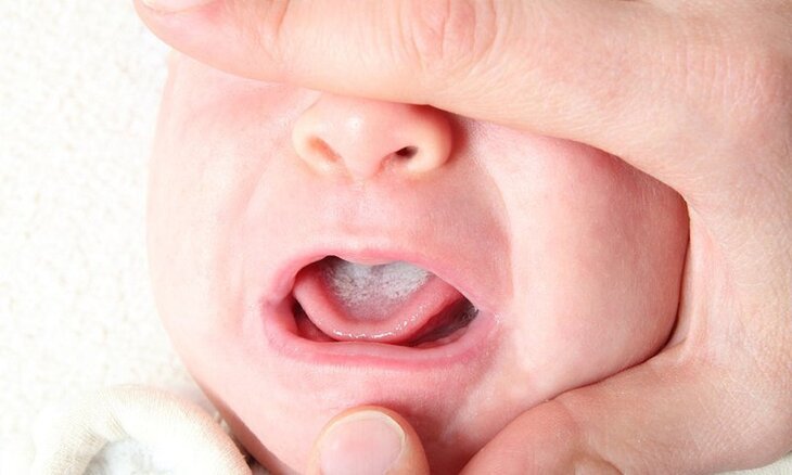 Lưỡi bé bị trắng là căn bệnh đang ngày càng phổ biến hiện nay