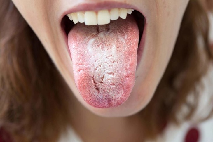 Lưỡi trắng xuất hiện các mảng bám trắng dày là một những biểu hiện cơ bản của tình trạng này