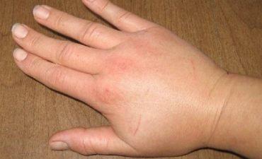 Có nhiều nguyên nhân dẫn đến tình trạng ngón tay bị sưng phù và ngứa