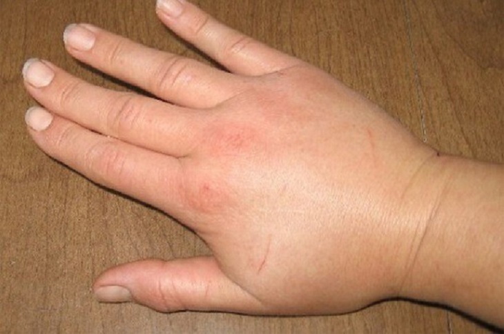 Có nhiều nguyên nhân dẫn đến tình trạng ngón tay bị sưng phù và ngứa