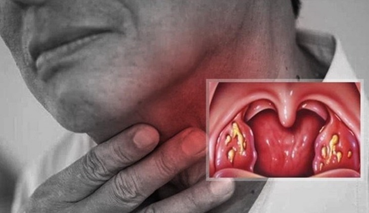Viêm họng hạt mãn tính là một trong những bệnh hô hấp tiềm ẩn nhiều biến chứng nguy hiểm