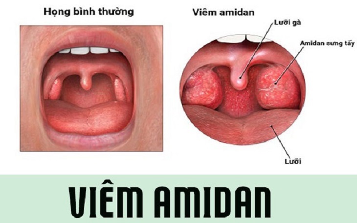 Bị viêm amidan mãn tính cũng là nguyên nhân dẫn đến viêm họng hạt mãn tính