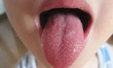 Viêm họng hạt ở lưỡi là một dạng của bệnh viêm họng