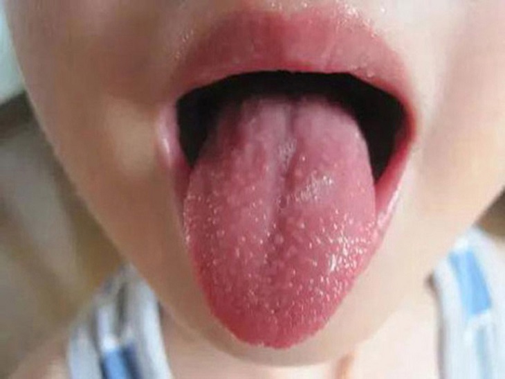 Viêm họng hạt ở lưỡi là một dạng của bệnh viêm họng