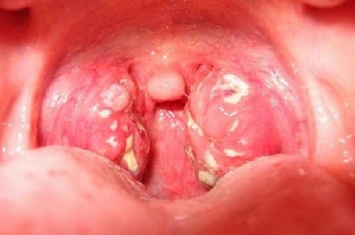 Viêm họng liên cầu khuẩn nhóm A là tình trạng niêm mạc họng bị nhiễm trùng