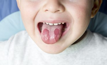 Viêm lưỡi bản đồ là một trong những bệnh về khoang miệng thường gặp ở trẻ em
