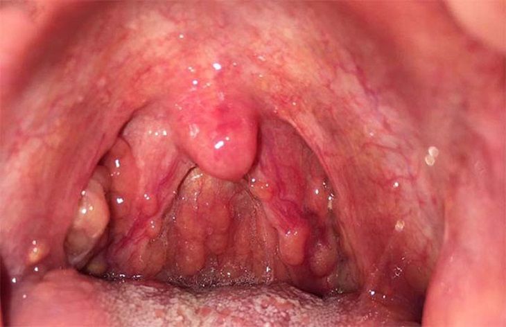 Viêm họng hạt khởi phát do sự phát triển quá mức của tổ chức lympho sau thành họng