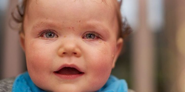 Viêm kết mạc là nguyên nhân gây cho trẻ bị viêm mí mắt dưới