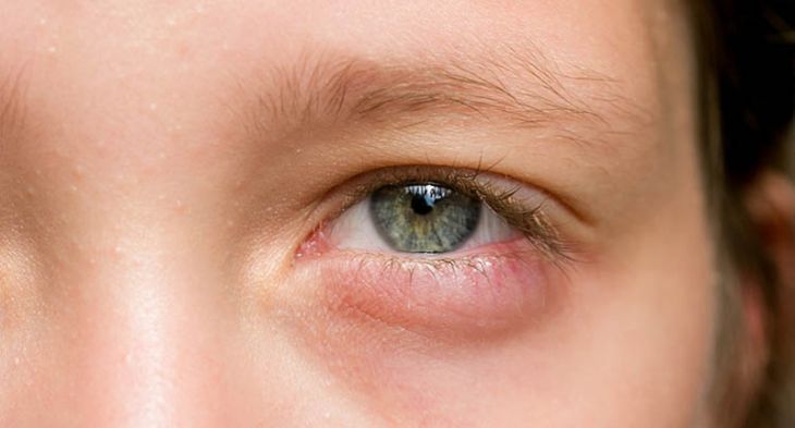 Trẻ bị sưng mí mắt dưới gây ra rất nhiều khó chịu cho bé