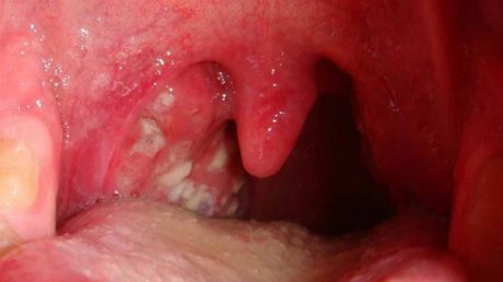 Viêm họng hạt có mủ là một trường hợp của bệnh viêm họng mãn tính, quá phát ở mức độ nặng