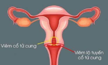 Viêm cổ tử cung có nguy hiểm không là thắc mắc chung của rất nhiều chị em hiện nay