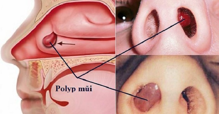 Viêm xoang polyp mũi là tình trạng tổn thương giả u thường gặp ở những người bị viêm xoang mãn tính