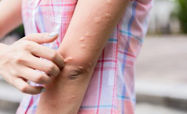 Mề đay, phát ban, nổi mẩn ngứa trên da là một trong những triệu chứng mà người nhiễm biến chúng Omicron đang gặp phải