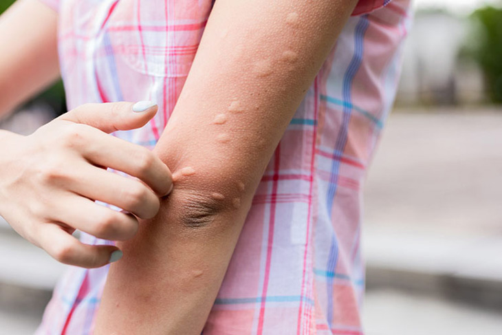Mề đay, phát ban, nổi mẩn ngứa trên da là một trong những triệu chứng mà người nhiễm biến chúng Omicron đang gặp phải