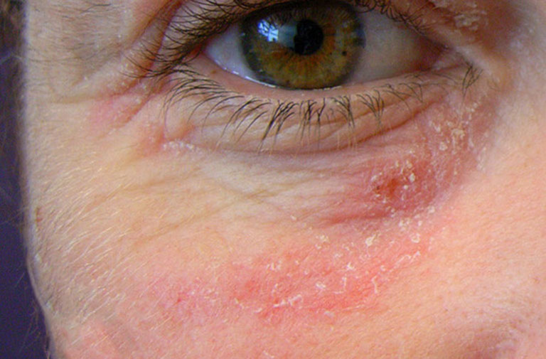 Nhận biết triệu chứng nổi mề đay quanh mắt