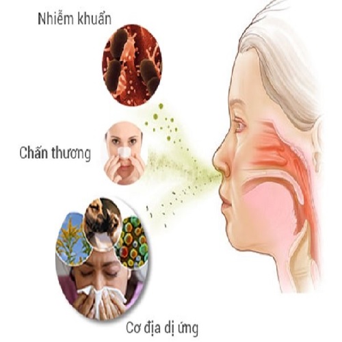 Nguyên nhân viêm mũi dị ứng 