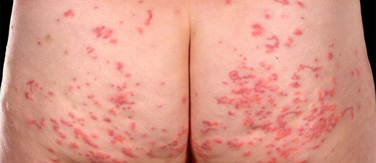 Nổi mề đay ở mông có thể là dấu hiệu của bệnh chàm da