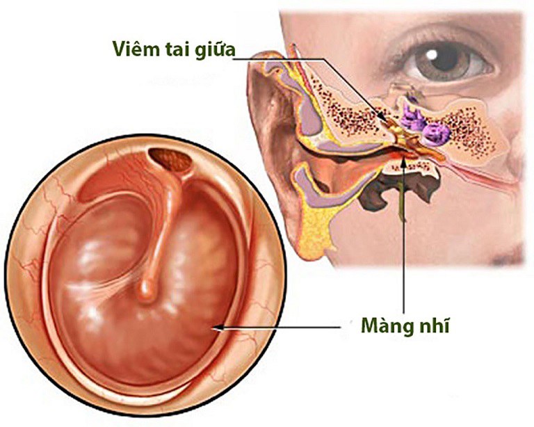 Bệnh viêm tai giữa khiến lỗ tai tai bị sưng đau nhức bên trong