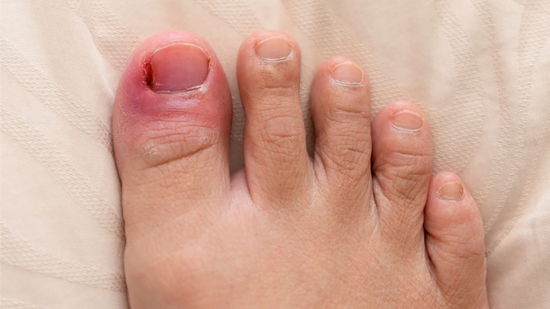 Ngón chân cái bị sưng đau mưng mủ do nấm móng