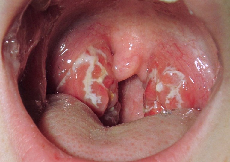 Đau họng khi nuốt nước bọt có thể do viêm amidan hoặc viêm họng gây ra