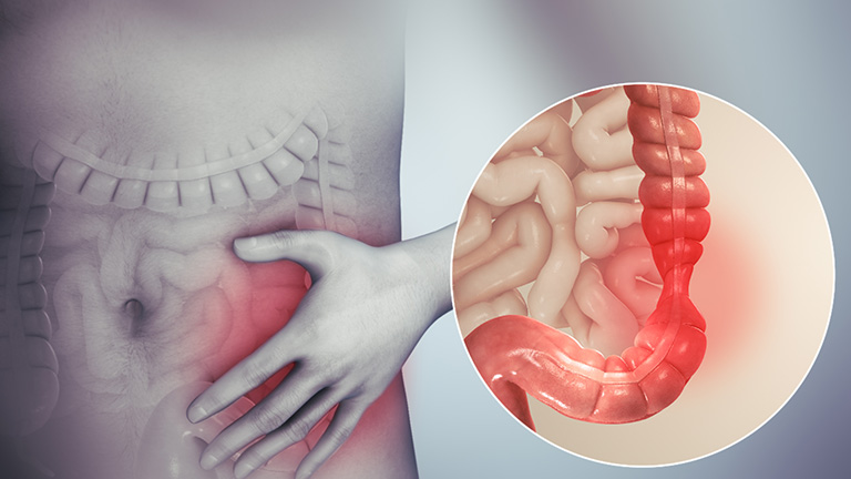 Hội chứng ruột kích thích gây đau bụng dưới kèm đầy hơi, khó tiêu
