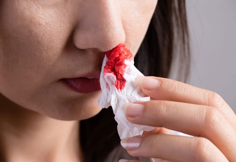 Sổ mũi ra máu là tình trạng trong dịch mũi có lẫn một chút máu