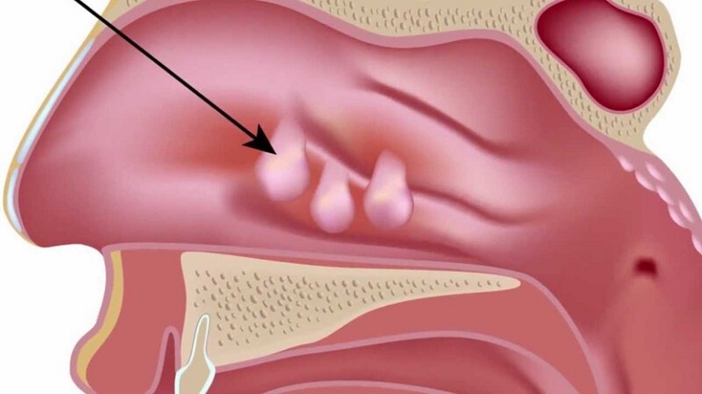Sổ mũi ra máu có thể do trong mũi có khối u