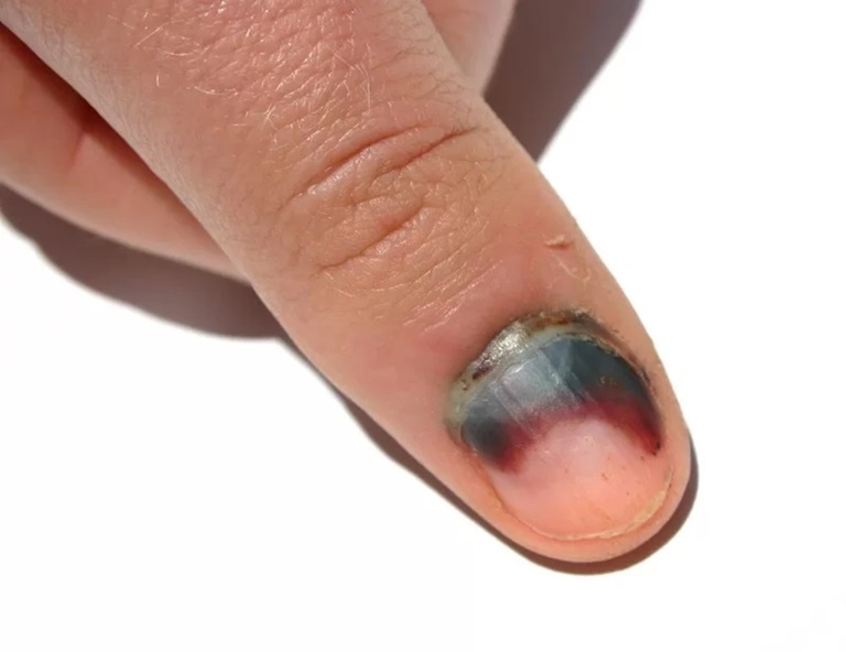 Bầm tím ở ngón tay có thể do bệnh ung thư gây ra
