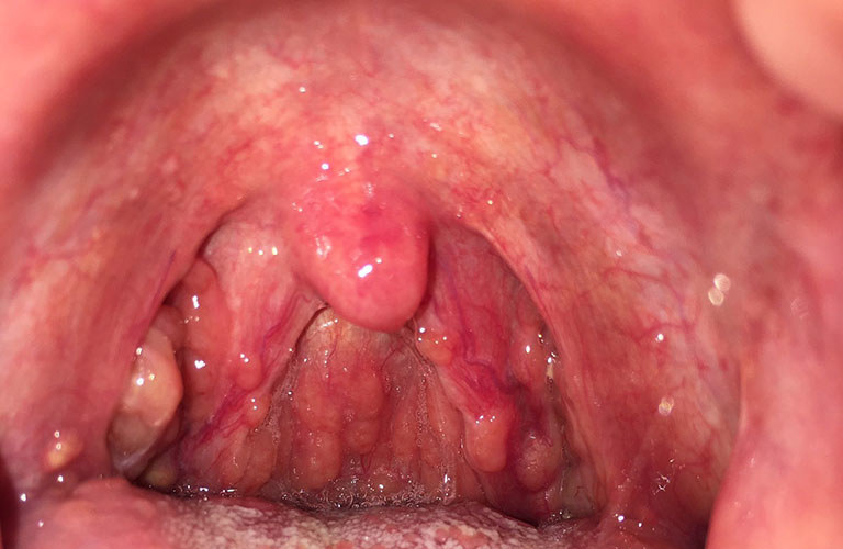 Cuống lưỡi nổi mụn trắng xảy ra do nhiều nguyên nhân
