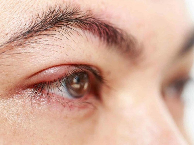 Có rất nhiều nguyên nhân dẫn đến hiện tượng mí mắt bị sưng sau khi ngủ dậy