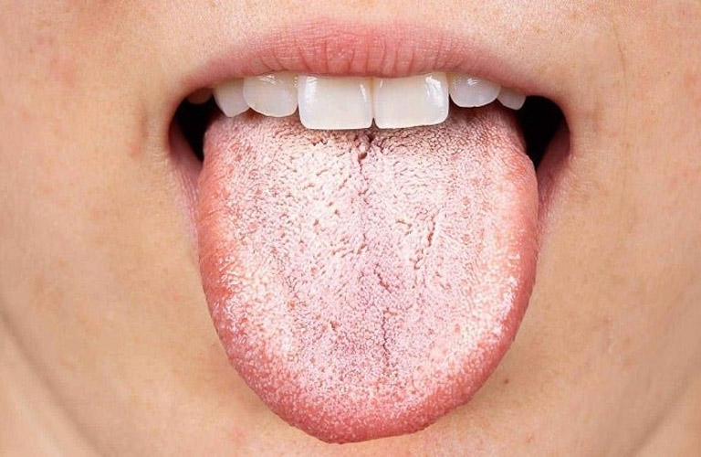 Bệnh nấm miệng với triệu chứng điển hình là lưỡi trắng