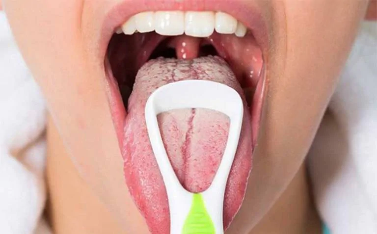 Trào ngược dạ dày lưỡi trắng là một trong những bệnh lý về đường tiêu hóa mà rất nhiều người gặp phải