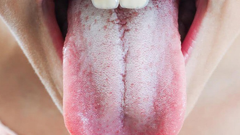 Triệu chứng trào ngược dạ dày lưỡi trắng