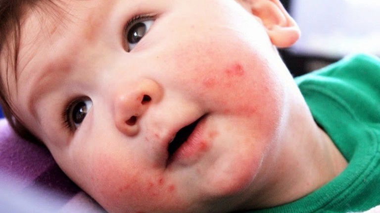 Cần thăm khám bác sĩ để tìm ra nguyên nhân khiến trẻ bị nổi mẩn đỏ quanh miệng