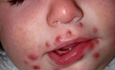 Trẻ Bị Nổi Mẩn Đỏ Quanh Miệng Là Dấu Hiệu Bệnh Gì? Cách Phòng Ngừa