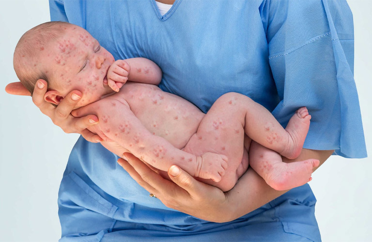 Sốt phát ban ở trẻ sơ sinh bị nổi mẩn đỏ ở chân