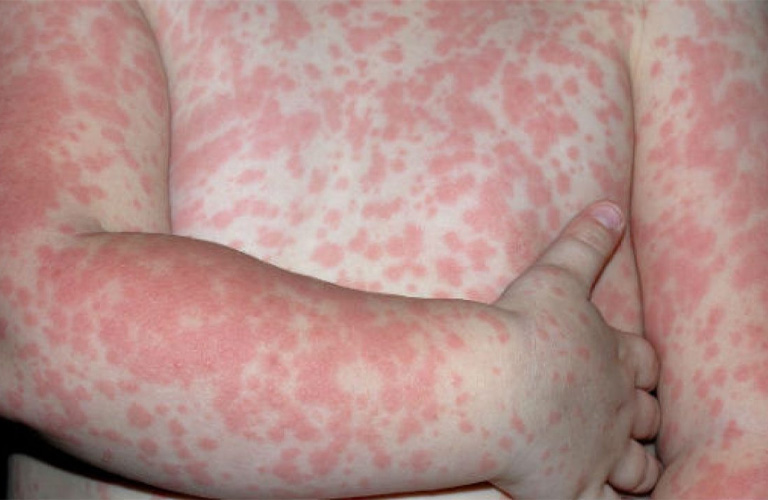 Trẻ sơ sinh nổi mẩn đỏ ở cổ do sốt phát ban
