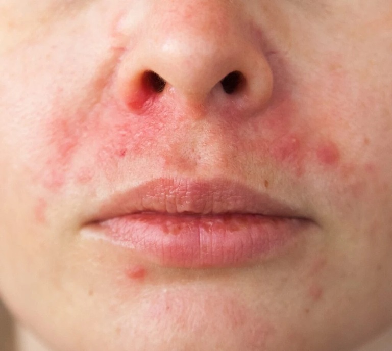 Bị ngứa quanh miệng có thể là dấu hiệu của bệnh viêm da