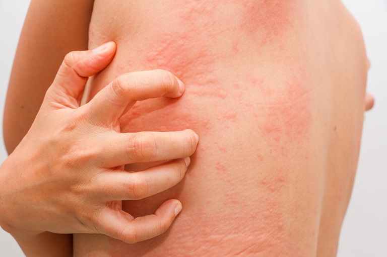 Da khô ngứa toàn thân có thể là dấu hiệu của bệnh viêm da dị ứng