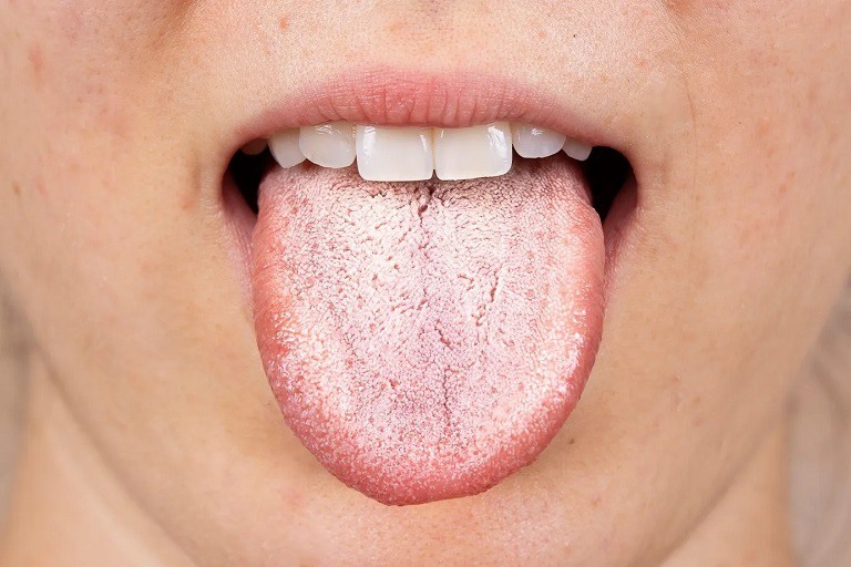 Gai lưỡi trắng thường không gây nguy hiểm cho sức khỏe