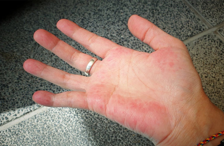Bệnh mề đay là nguyên nhân gây mẩn đỏ ngứa ở mu bàn tay